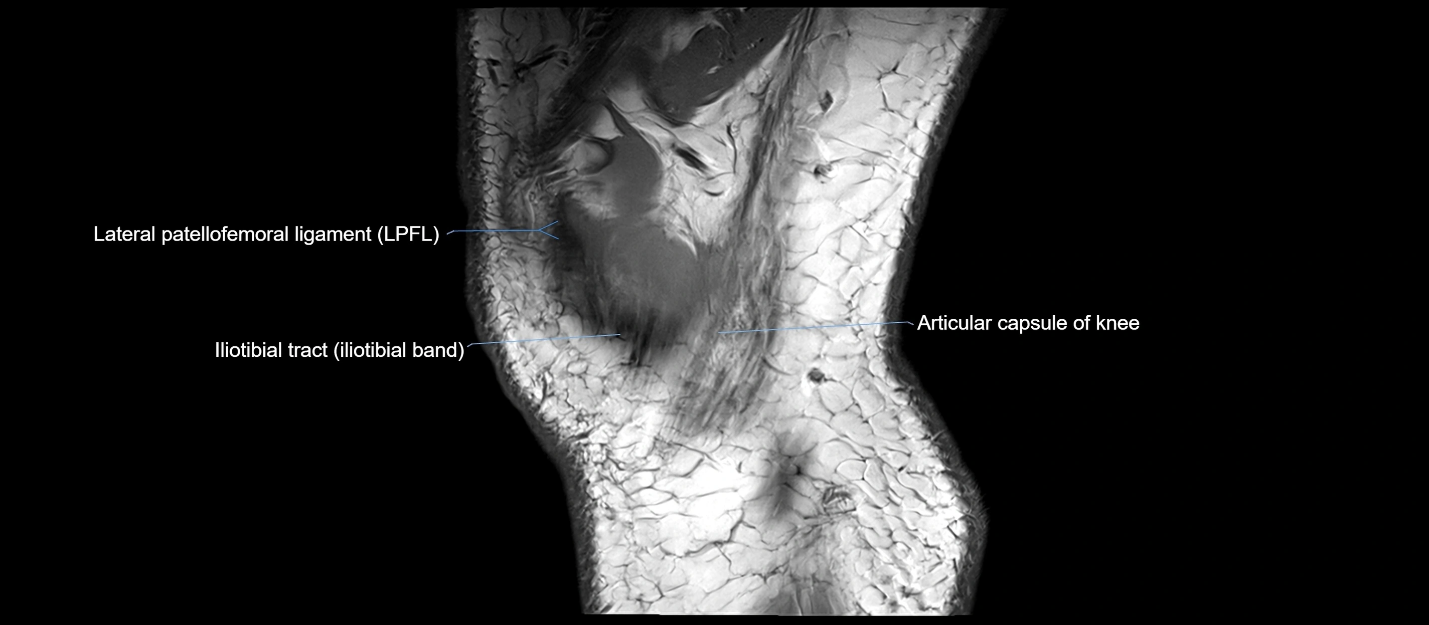 MRI sagittal  ligaments cross sectional anatomy 3T  radiology  image-img-00001-00043.webp